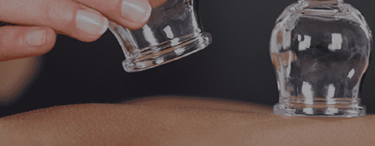 Cupping Mile-High-Physical-Therapy-Montville-NJ