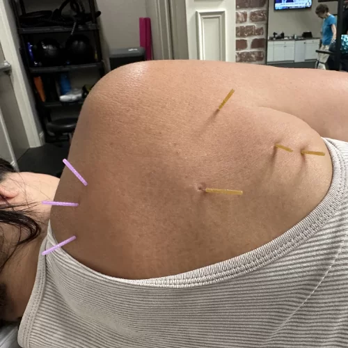 physical-therapy-dry-needling-Mile-High-Physical-Therapy-Pine-Brook-NJ-500px (1)